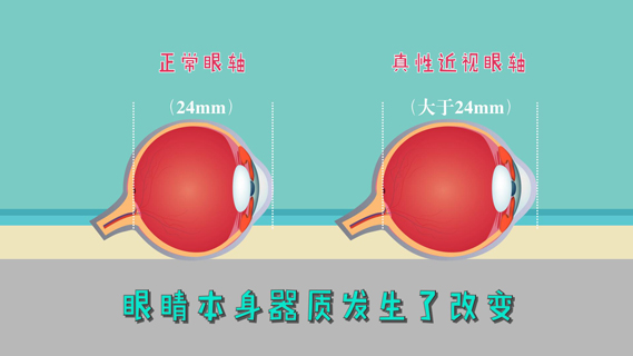 戴眼镜要多少度_300多度需要戴眼镜吗贴吧_几百度眼镜要一直戴
